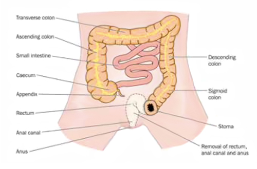 Stoma Diagram