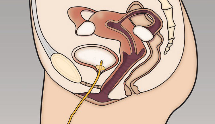 Indwelling Catheter - Bladder & Bowel Community