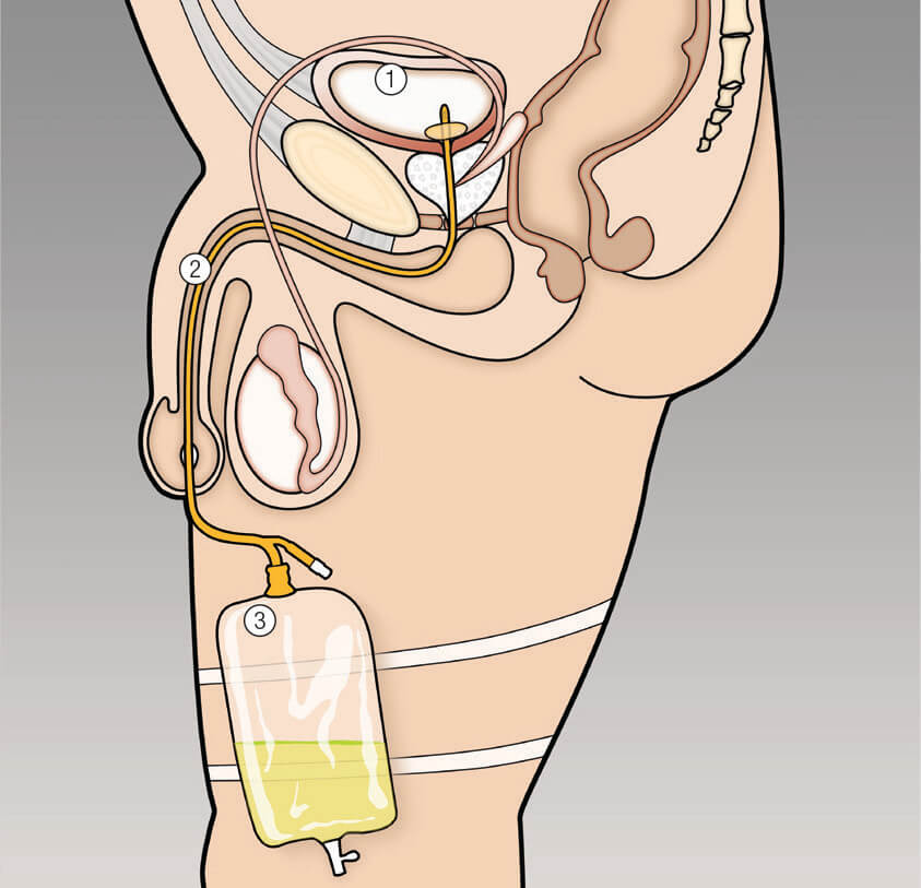 Male Catheter