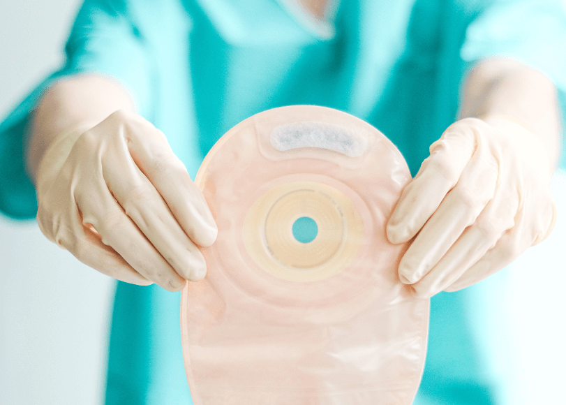 Stoma Surgery